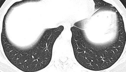 TÓRAX (janela pulmonar) Ligamento pulmonar inferior L