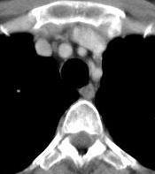 TÓRAX (janela mediastinal) Veia braquiocefálica direita Artéria inonimada