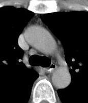 TÓRAX (janela mediastinal) Espaço pré-vascular (loja tímica) Aorta