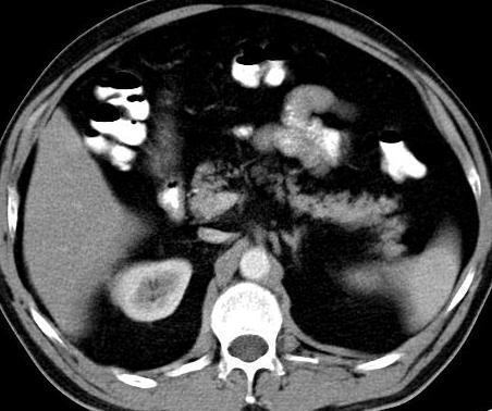 ABDOME Segmento V Cabeça pancreática Duodeno