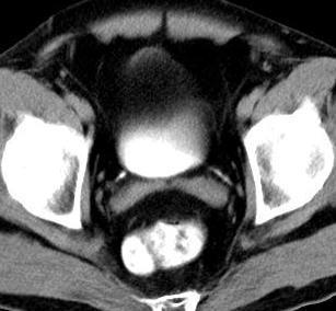 PELVE (masculina) Ureter distal Bexiga