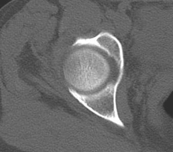 BACIA / QUADRIL Acetábulo anterior