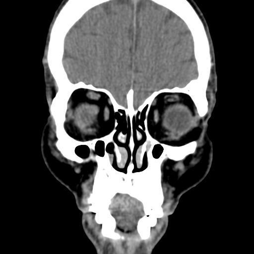 SEIOS DA FACE Processo zigomático (osso frontal)