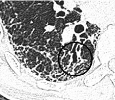 Bronquiectasias por tração: Dilatação brônquica irregular causada por uma fibrose pulmonar retrátil.