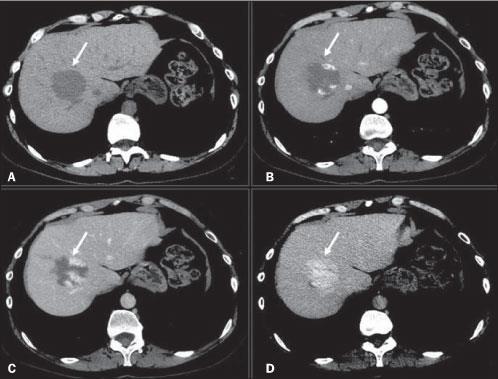 Hemangioma TC : - Preenchimento Globuliforme periférico centrípeto