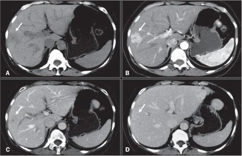 TC: Hiperplasia Nodular Focal (HNF) - Lesão lobulada e bem delimitada - Iso ou hipoatenuante - Realce