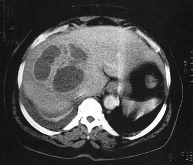 Abscesso hepático