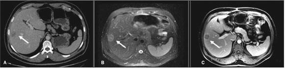 Metástases Hepáticas TC E RM -
