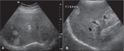 Hemangioma US: hiperecogénico, homogêneo, bem delimitado.