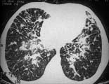 Dia 27.04.2008 - Manhã Médico - Pneumologia 35. A redistribuição do fluxo sangüíneo pulmonar é facilmente reconhecida radiograficamente e indica hipertensão venocapilar pulmonar.