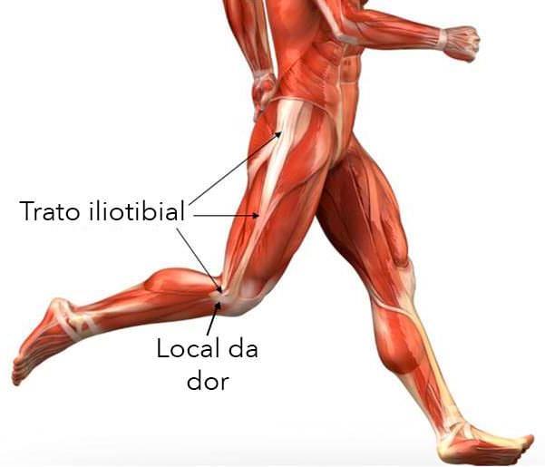 Síndrome da banda iliotibial Joelho de corredor É uma lesão de sobrecarga, ou esforço, provocada por múltiplos movimentos repetidos.