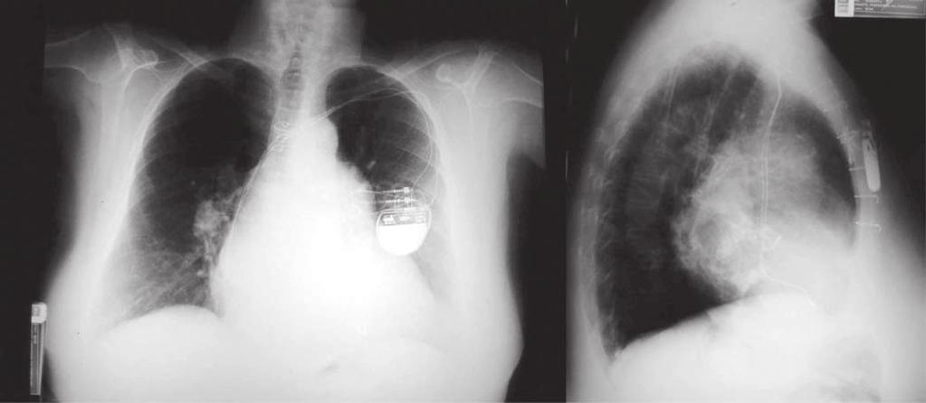 A ecocardiografia transtorácica realizada no pós-operatório evidenciou presença de hipertrofia miocárdica residual (septo interventricular com espessura de 1,8 cm), com função do ventrículo esquerdo