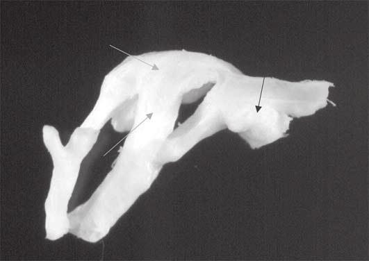 Em razão do quadro clínico de estenose mitral grave, optouse pelo tratamento cirúrgico da valva mitral, sendo realizada a troca da valva por uma prótese mecânica St. Jude 25 mm.