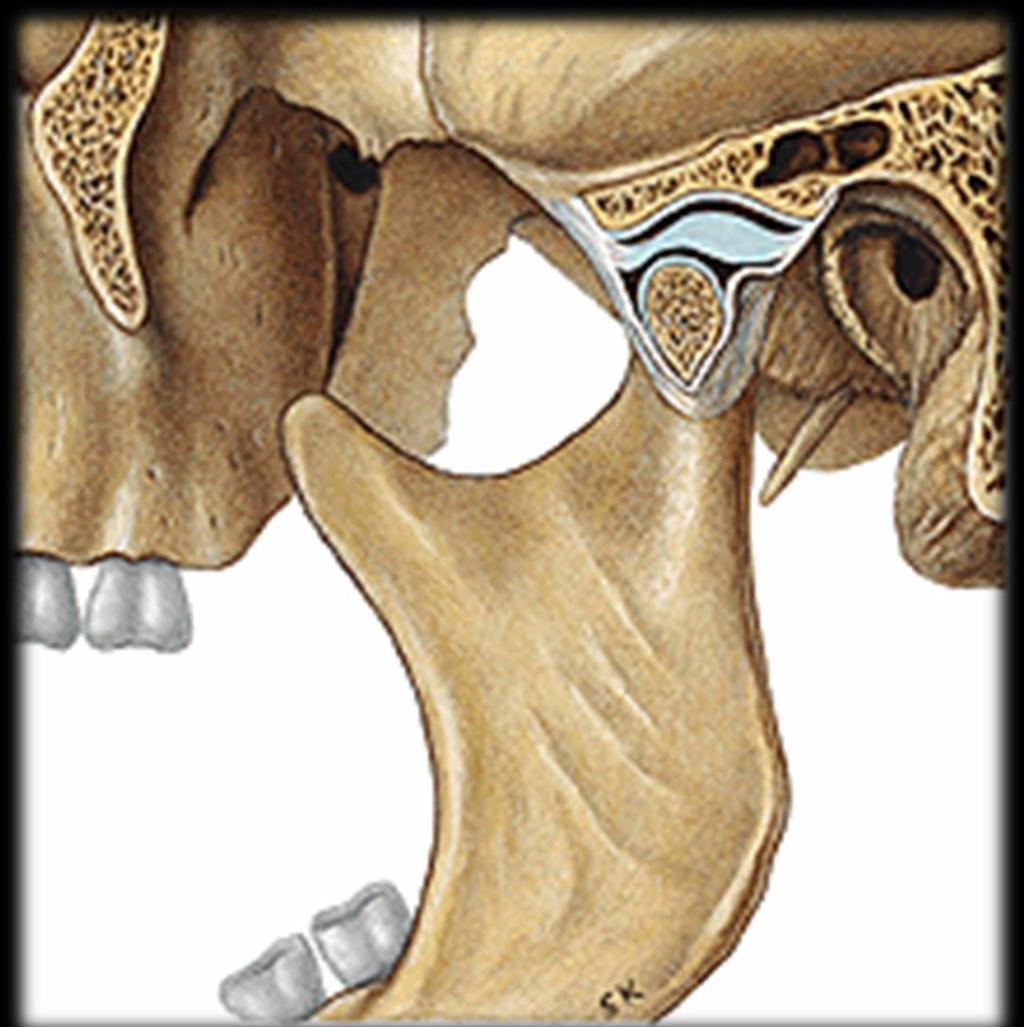 DISCO ARTICULAR DA ATM Superfícies ósseas incongruentes articulação instável Placa