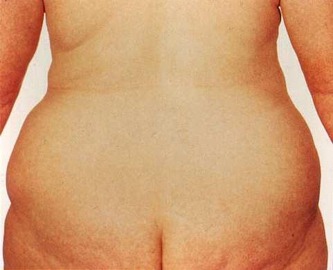 Quantidade versus localização da gordura mulher As
