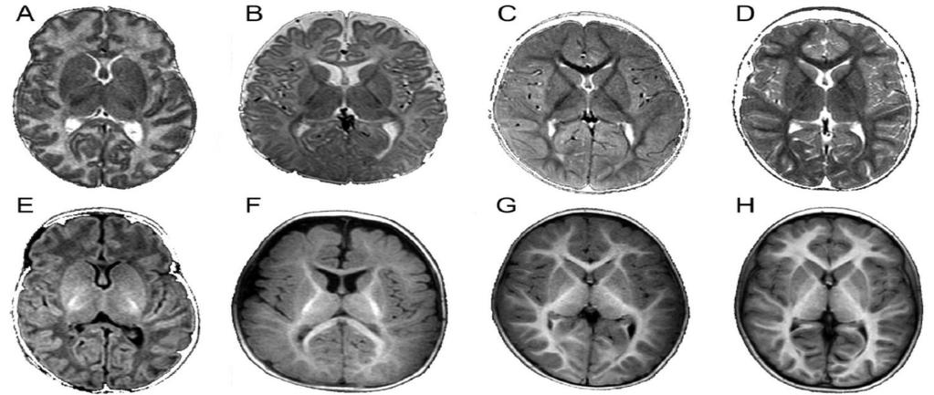 28 Figura 2. Imagens normais em T2 (A-D) e T1 (E-H), em neonatos a termo (A,E) e nas idades de 5 meses (B,F), 1 ano (C,G) e 5 anos (D,H).