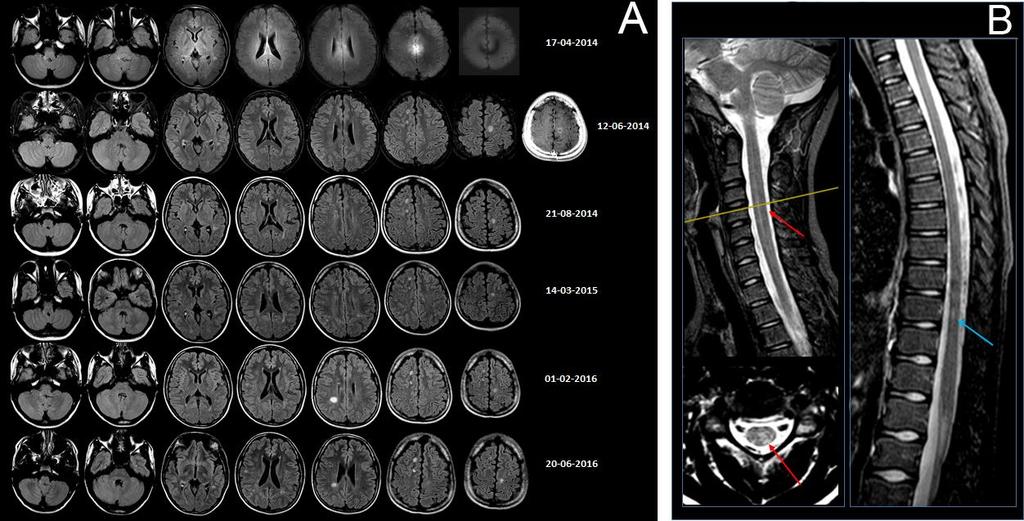 58 Figura 2 Figura 2. - RM de paciente com Esclerose Múltipla. A) RM do crânio. Evolução temporal e espacial das lesões mielinoclásticas. B) RM das colunas cervical e dorsal.