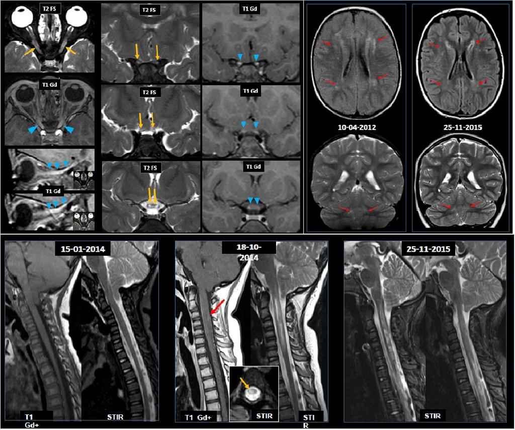 59 Figura 3 A B C Figura 3. - RM de paciente com Neuromielite Óptica A) RM de orbitas (10/04/2012).
