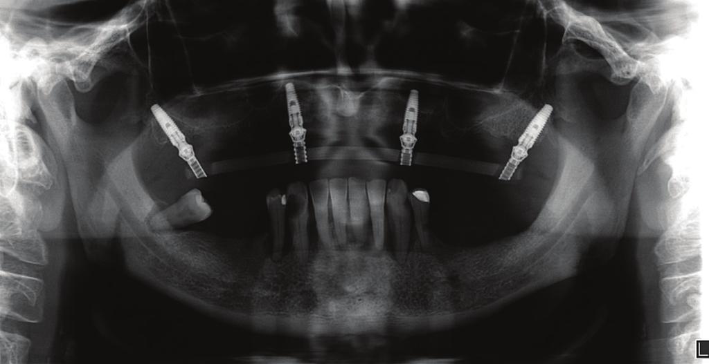 O paciente ocluiu, para assegurar o correto do implante) foi utilizada (300 rpm) para prover estabilidade posicionamento da prótese, e os cilindros foram conectados primária.