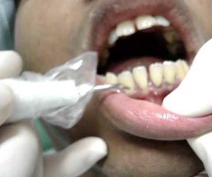 através das curetas. Juntamente com a instrução sobre higiene oral, consiste na terapia básica para controlar a infecção periodontal.