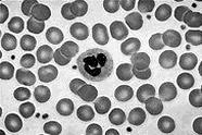 coagulação A anemia caracteriza-se por uma deficiência no tamanho e número de eritrócitos (hemácias) (fig.1), ou na quantidade de hemoglobina que eles contém.
