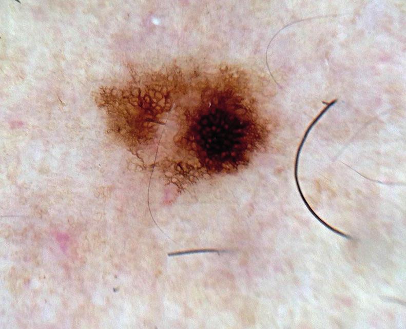 Como este padrão é também observado em alguns melanomas de crescimento superficial recomendava a sua excisão ou monitorização a curto prazo. Se a área hiperpigmentada crescer devem ser excisados.