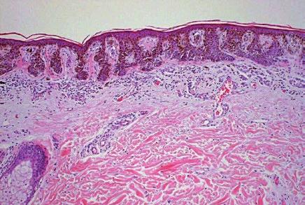A Figura 7 - Proliferação de melanócitos com fusão das cristas epiteliais, presença de infiltrado inflamatório linfocítico na derme superficial e perivascular, fibroplasia da derme papilar. (HE x10).