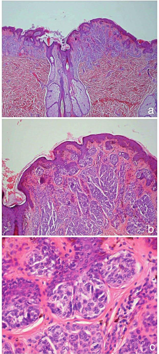 cristas epiteliais e de tecas de melanócitos, envolvimento do folículo piloso (A), com maturação dos melanócitos em profundidade (B).
