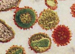 Vírus Human Immunodeficiency Virus (HIV) Esquema e microscopia eletrônica -