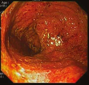 FIGURA 3 E 4 Transição ano-rectal e remanescente rectal ção foram desenvolvidos para diagnosticar a bolsite e avaliar a gravidade da doença, o índice de actividade de doença de bolsite 77 e o score