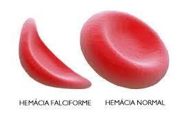 gera hemoglobinas que causam alteração nas hemácias, dando-lhes a forma de foice (falciforme), o que por si dificulta seu fluxo, principalmente nos capilares.