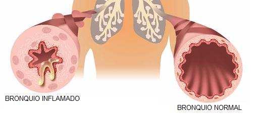 uma duração média de 1 a 2 semanas; Bronquite crônica: caracteriza-se por infecções recorrentes; os sintomas desaparecem