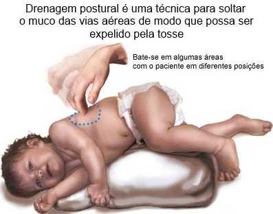 Bronquiectasia Tratamento O tratamento geral visa à drenagem do material purulento e manutenção do estado geral do paciente: Antibióticos para