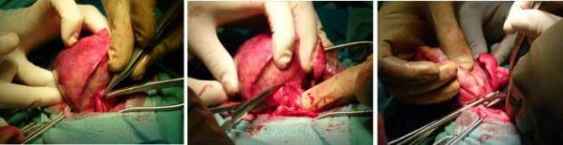 Bronquiectasia Tratamento cirúrgico (último caso): Extirpação da área afetada, indicada como meio de cura, em pacientes que apresentam pequena