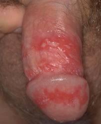 etiológico: Herpes simplex 2