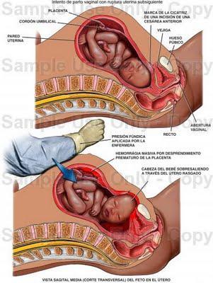 Rotura uterina DPP Embolia amniótica Imagem: