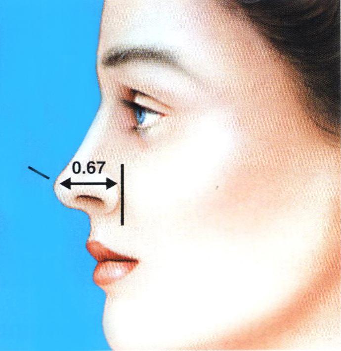 11 A projeção nasal é definida pela distância da ponta do nariz até o ponto mais posterior da junção naso-facial, isto é, a distância que o nariz projeta-se da face (Figura 5).