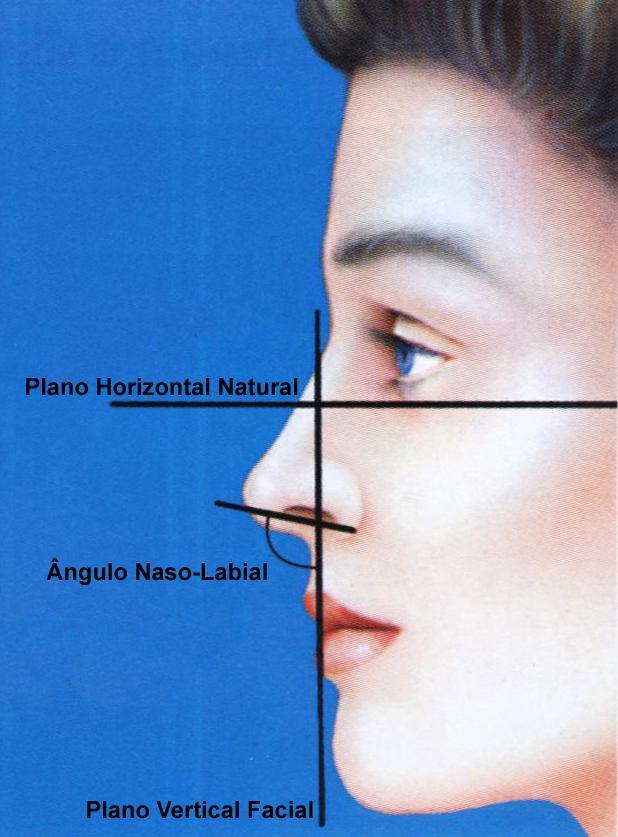 12 A rotação nasal é o movimento cefálico ou caudal da ponta nasal em relação ao plano vertical facial. Pode ser indiretamente avaliada pela mensuração do ângulo naso-labial.