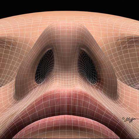 17 Fonte: Adaptado de Toriumi DM. New concepts in nasal tip contouring. Arch Facial Plast Surg 2006;8(3):156-185.