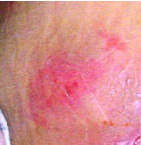 Lesão por Pressão Estágio 2 Perda da pele em sua espessura parcial com exposição da derme.