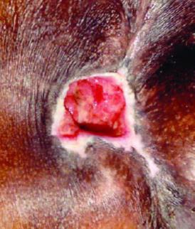 Lesão por Pressão Estágio 3 Perda da pele em sua espessura total na qual o tecido adiposo é visível e, frequentemente, tecido de granulação e epíbole (lesão com bordas enroladas) estão presentes.