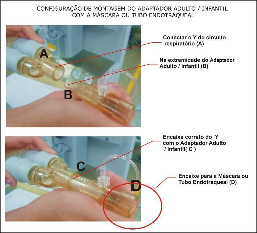 Montagem e preparação A configuração de montagem do adaptador neonatal com a linha de amostragem Nomoline, segue os mesmos passos da figura 81, utilizando o adaptador Luer Lock Neonatal.