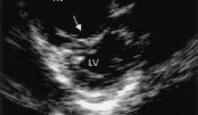 de espaço morto TEP maciço - shunt D E (intrapulmonar/ abertura de foramen oval) TEP maciço - DC SvO 2 Hipoxemia Em áreas mal ou não perfundidas