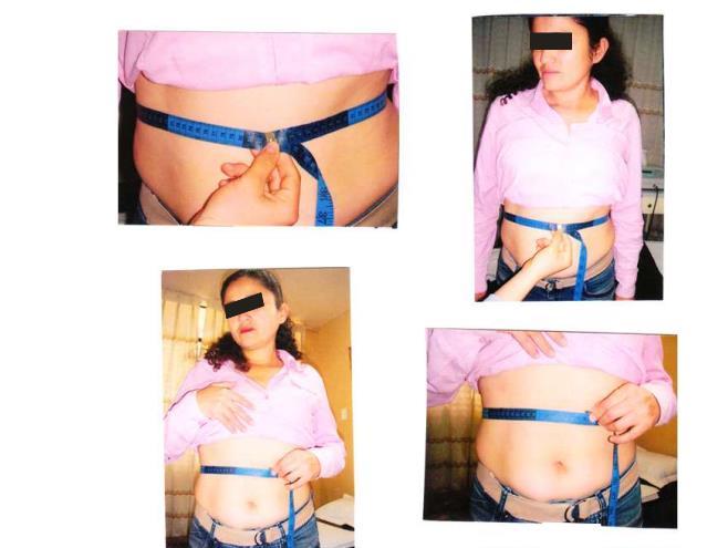 Figura 1: Paciente da pesquisa de 35 anos, que inicou a terapia de hidrolipoclasia com 80cm de perímetro de cintura