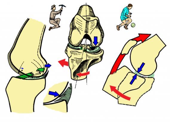 MENISCOS I - MECANISMO LESIONAL: A lesão do menisco interno se produz pela realização de um movimento forçado que associa flexão, rotação externa e adução com a perna em carga (se o pé-perna não
