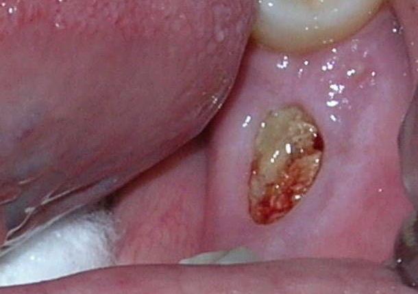 osteonecrose da mandíbula (<1%; aumenta se manipulações na cavidade oral) EVITAR
