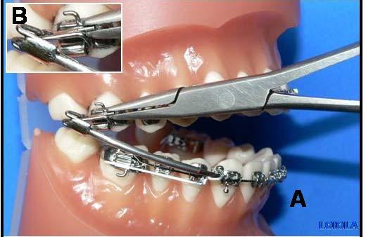 46 Adaptar o conjunto por mesial ao tubo molar superior (figura 19).