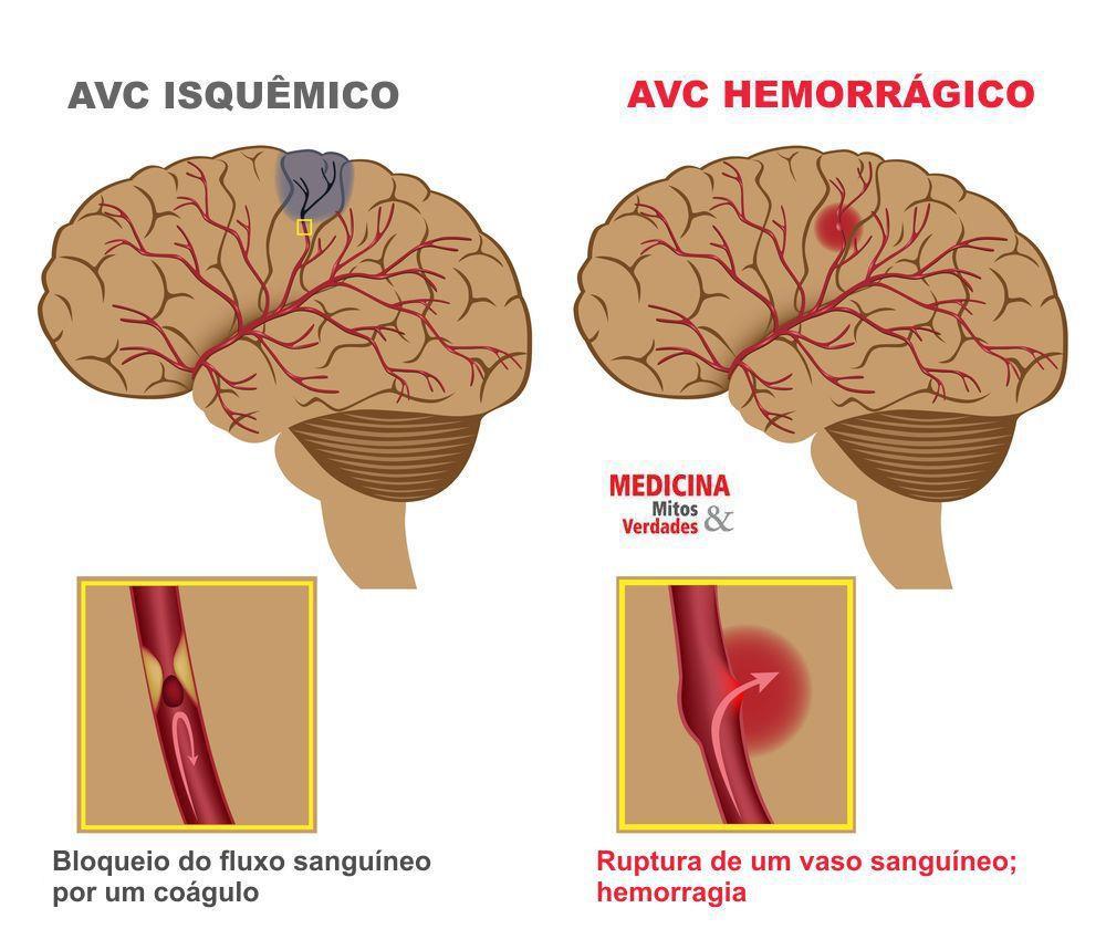 O AVC é dividido em dois subtipos, o isquêmico e o hemorrágico. O primeiro caso é o mais comum e se refere à obstrução ou redução brusca do fluxo sanguíneo de uma artéria cerebral.
