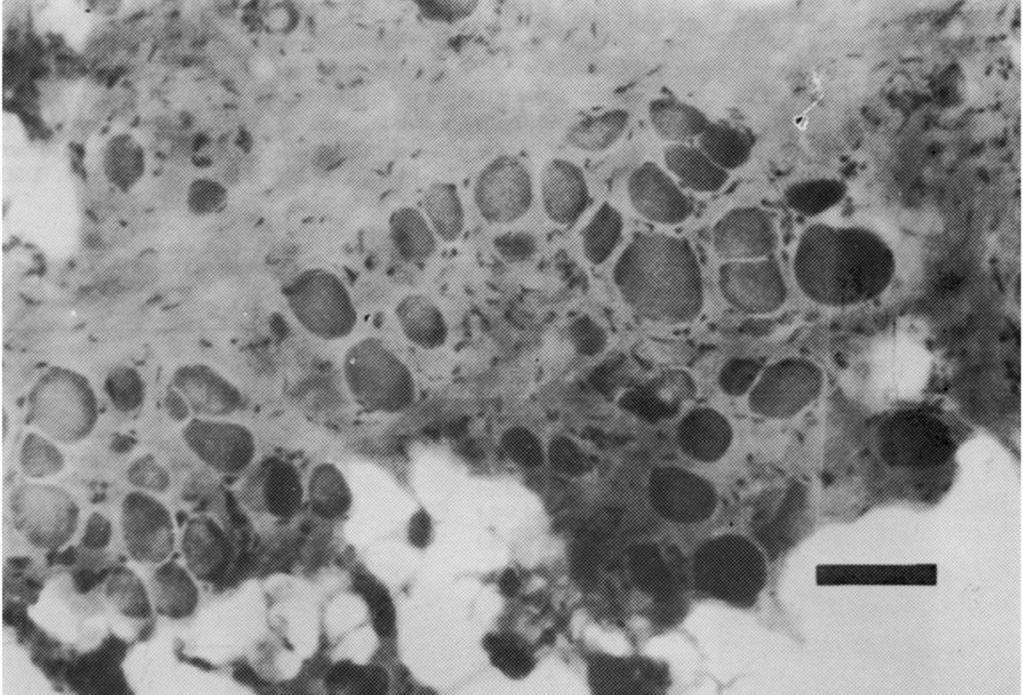 17 FIGURA 1- Biopsia muscular na DMD, presença de tecido conjuntivo e adiposo, fibras musculares atrofiadas. FONTE: Batista (2017, p.86).