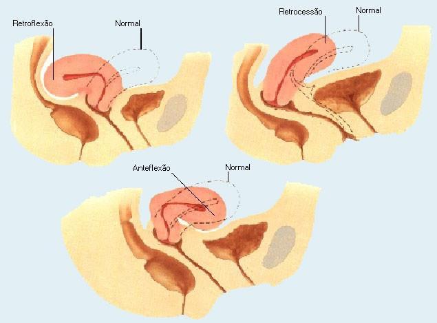 MODIFICAÇÕES LOCAIS - ÚTERO POSIÇÃO: Acentua-se anteflexão uterina (provoca polaciúria sinal precoce de gravidez) Dextrotorção uterina Intrapélvico até 12ᵃ semana